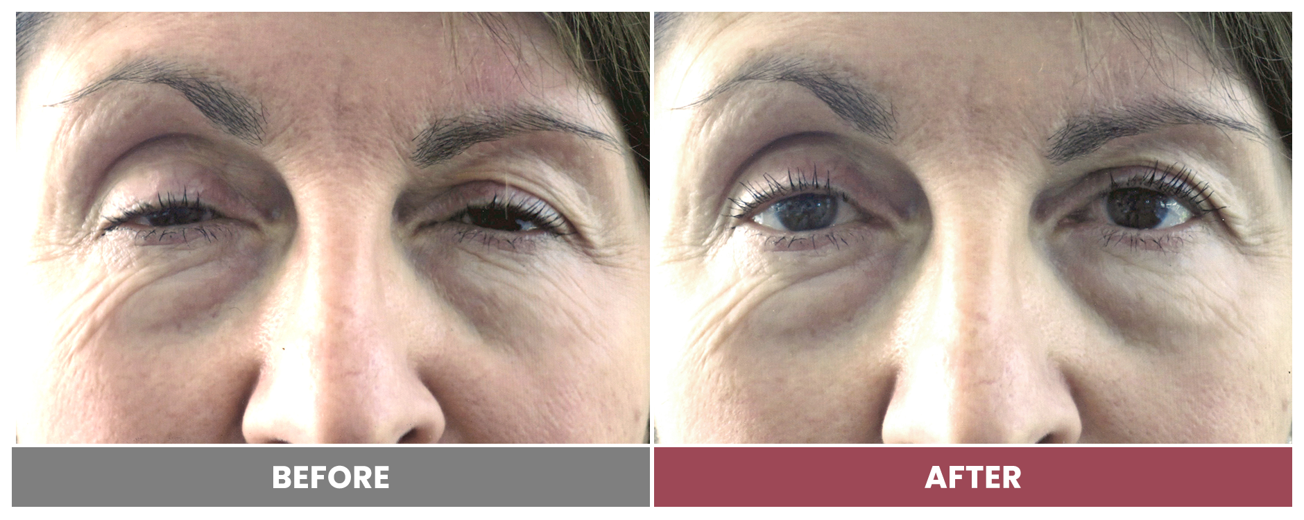PTOSIS REPAIR - Case 66